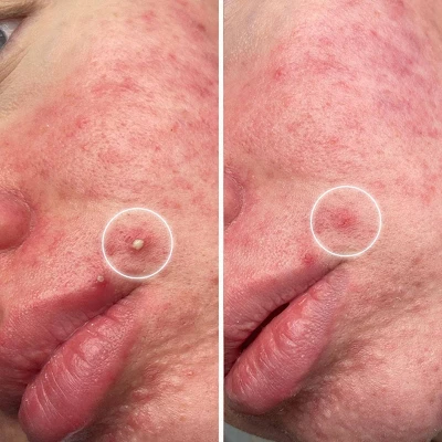 ZitSticka Goo Getter Surface Pimple Hydrocolloid Patch - 36ct 5 ZitSticka Goo Getter Surface Pimple Hydrocolloid Patch - 36ct - Image 5